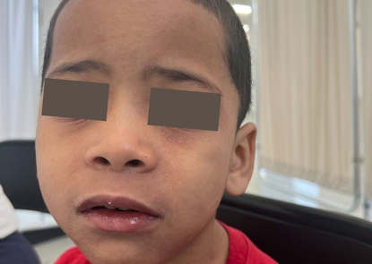 child with measles